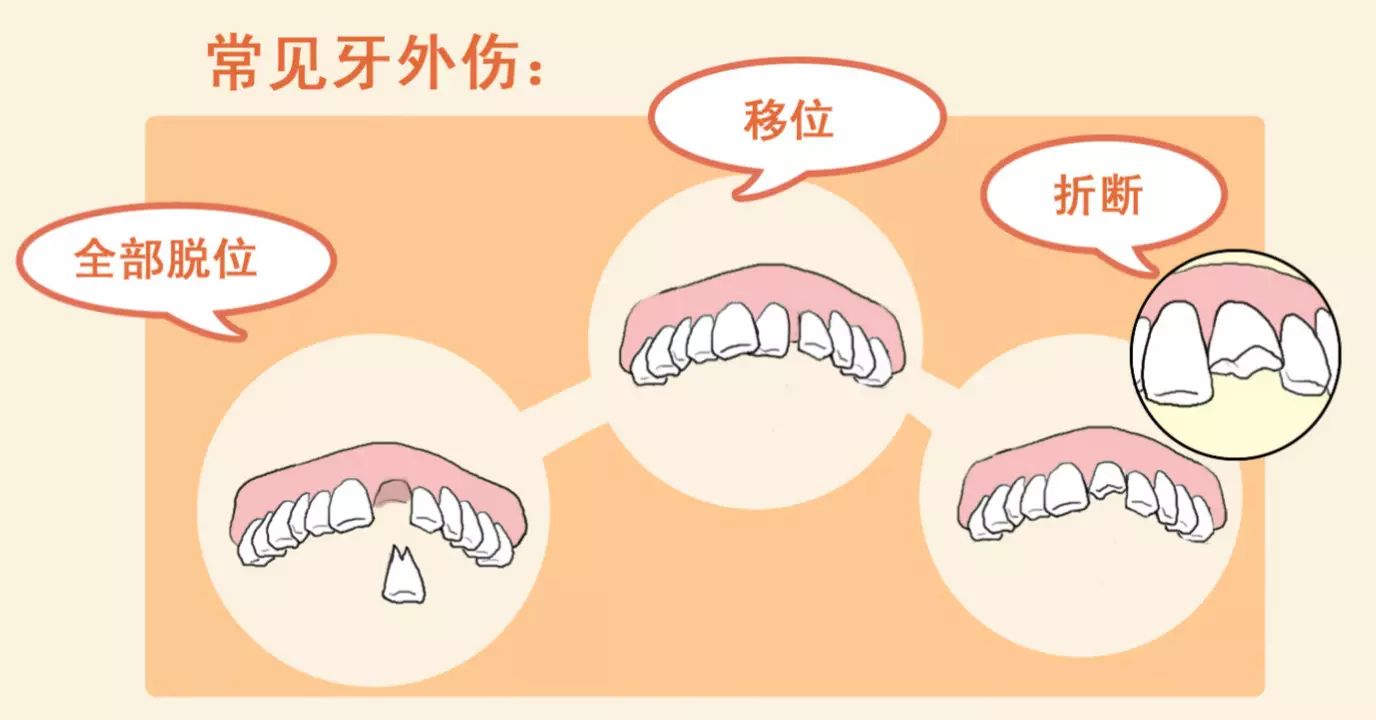 漲姿勢牙齒受傷怎麼辦